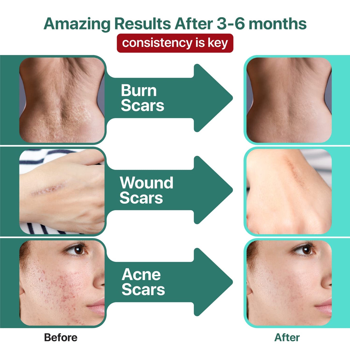 Ebanel Bundle of Lidocaine Numbing Cream, and Advanced Silicone Scar Gel 1 Oz Ebanel buy supplements Au